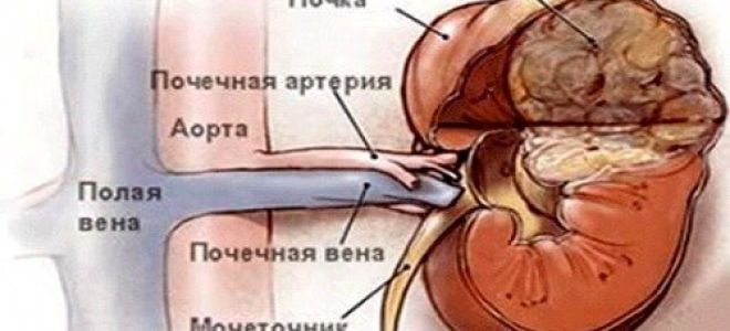 Гемартрома или ангиомиолипома правой почки: симптомы и признаки