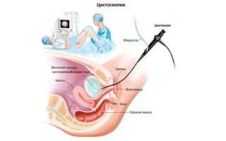 Как делают цистоскопию мочевого пузыря у женщин