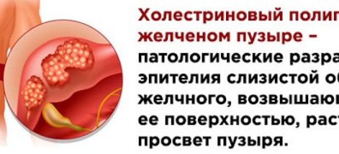 Полип в желчном что это. Полипы в желчном пузыре лекарства. Холестериновые полипы в желчном пузыре. Лекарство от полипов в желчном.