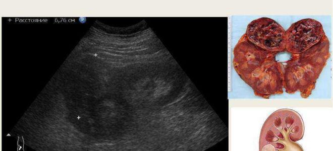 Опухоль почки — симптомы, лечение и сколько живут с этой болезнью