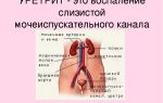 Воспаление мочеиспускательного канала (уретры)