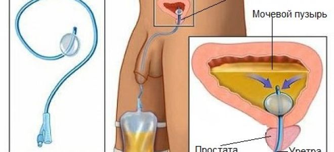 Катетер для мочеиспускания — для чего нужен и как применять