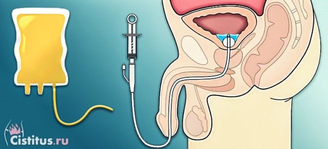 Инстилляция мочевого пузыря — когда и зачем делают