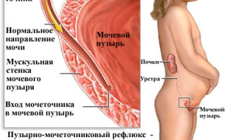 Заболевания мочеточника у женщин — симптомы и лечение