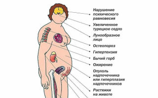 Симптомы заболеваний надпочечников у женщин