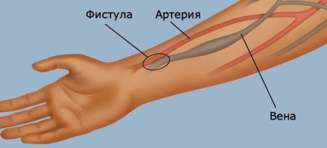 Что такое фистула у человека — как избавиться