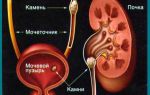 Мочекаменная болезнь симптомы и лечение у мужчин