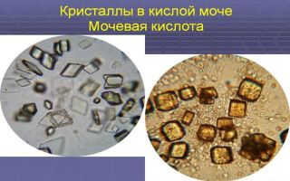 Причины появления фосфатов (кристаллов) в моче