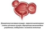 Симптомы и методы лечения дивертикула мочевого пузыря