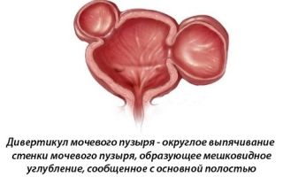 Симптомы и методы лечения дивертикула мочевого пузыря