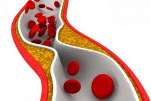 Секвестранты желчных кислот – лекарства против повышенного холестерина
