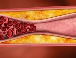 Холестериновый полип желчного пузыря: опухолевый дефект органа