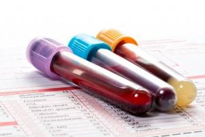 Анализ крови, АЛТ, АСТ, билирубин – что такое, и каковы показатели нормы
