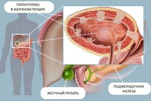 Холестериновый полип желчного пузыря: опухолевый дефект органа