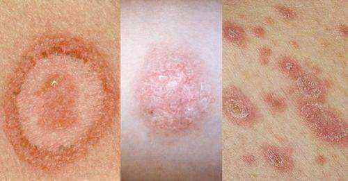 Сыпь при гепатите – результат нарушения функциональности печени