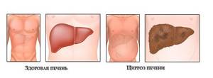 Последняя стадия цирроза печени: симптомы распада тканей