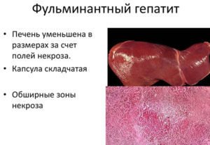Фульминантный гепатит – опасная форма воспаления при гепатите В