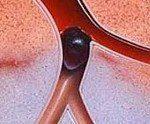 Тромбоз воротной вены: диагностика и лечение недуга