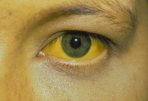 Паренхиматозная желтуха: причины, последствия, лечение