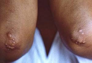 Холестатический гепатит – воспаление, вызванное нарушениями желчеоттока