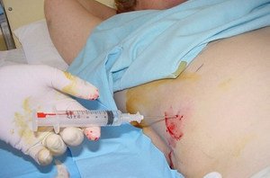 Поверхностный антиген вируса гепатита В – специфический маркер