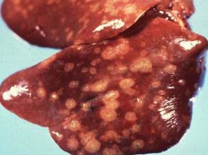 Некроз печени – отмирание гепатоцитов органа