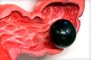 Цвет мочи при циррозе печени: причины и последствия заболевания