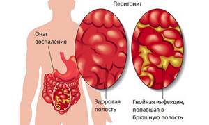 Билиарный панкреатит: почему возникает и как лечить заболевание