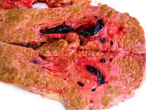 Портальный цирроз печени – следствие ряда гепатотропных факторов