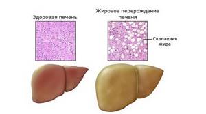 Дистрофия печени — видоизменение клеток органа