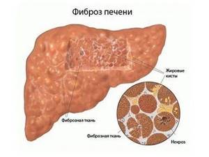 Фиброз печени 4 степени: прогноз при гепатите С и особенности лечения