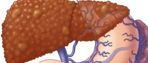 Портальный цирроз печени – следствие ряда гепатотропных факторов