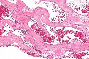 Кавернозная гемангиома печени: поражение органа малой опухолью