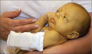 Врожденный гепатит: причины, диагностика, лечение и профилактика