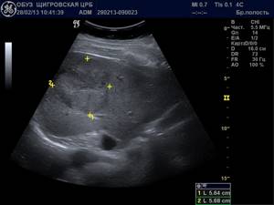 УЗИ печени при циррозе: описание и информативность процедуры