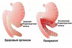 Симптомы болезни печени и поджелудочной железы: тревожные признаки