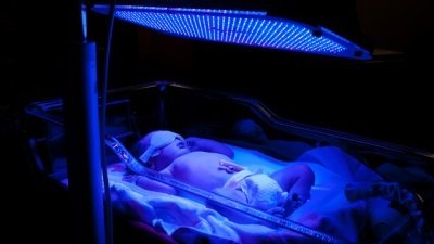 Фототерапия при желтухе новорожденных как успешное лечебное направление