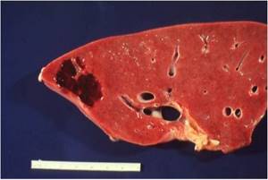 Кавернозная гемангиома печени: поражение органа малой опухолью