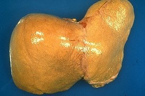 Гепатоз печени: особенности протекания и схема лечения патологии