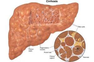 Криптогенный цирроз печени: причины, симптомы, диагностика и лечение