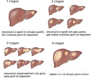 Гемангиома печени: симптомы заболевания и причины