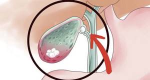Почему болит желчный пузырь: механизмы, запускающие болезни органа