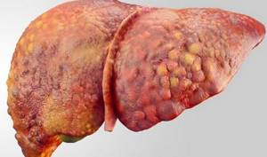 Жировой гепатоз печени: эффективное лечение народными средствами