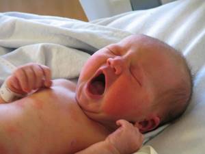 Желтуха у новорожденных: причины и способы лечения