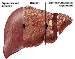 Острый гепатит – воспалительный процесс в клетках печени