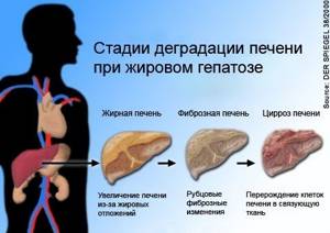Жировой гепатоз печени: лечение зависит от причин заболевания