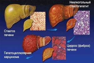 Гепатоз печени: особенности протекания и схема лечения патологии