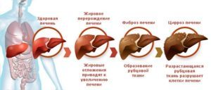 Сколько живут с циррозом печени: стадии заболевания и прогноз