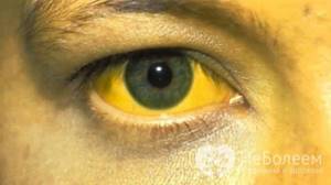 Механическая желтуха: причины, симптомы, лечение