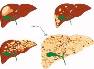Поликистоз печени – это хроническая патология наследственного характера